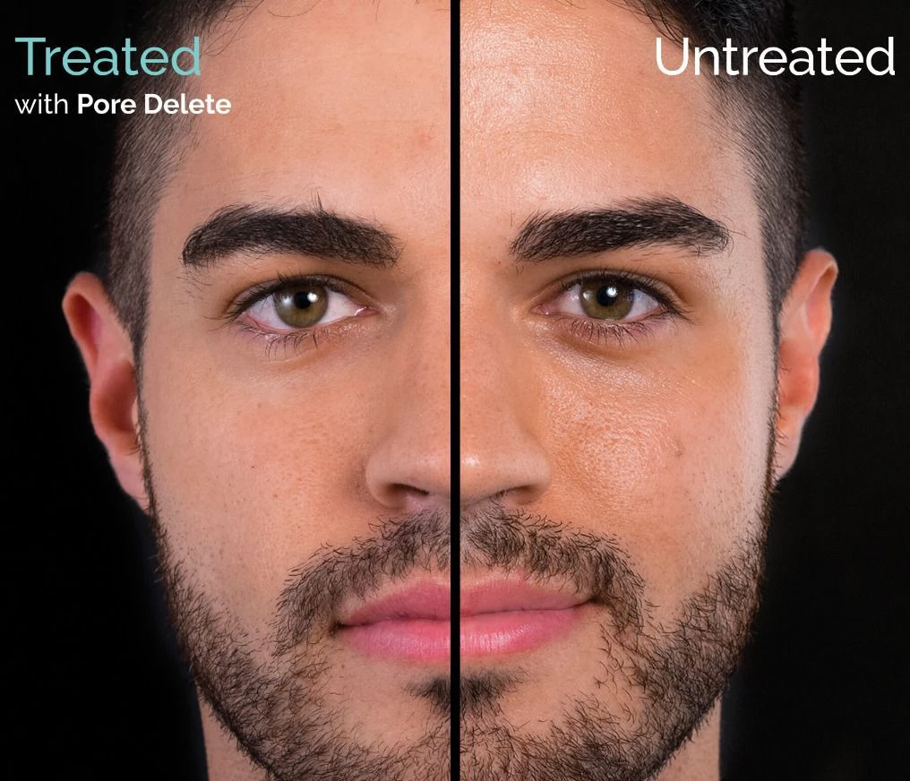 Hylamide Pore Delete 30ml 3 Hylamide Pore Delete 30ml - Image 3